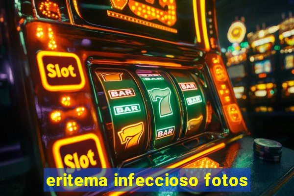 eritema infeccioso fotos